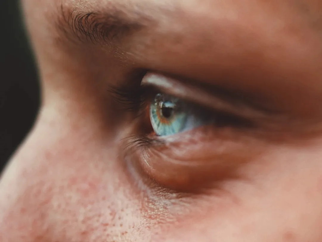 Vitiligo on Eyelids: Can You Treat Near the Eyes Safely?