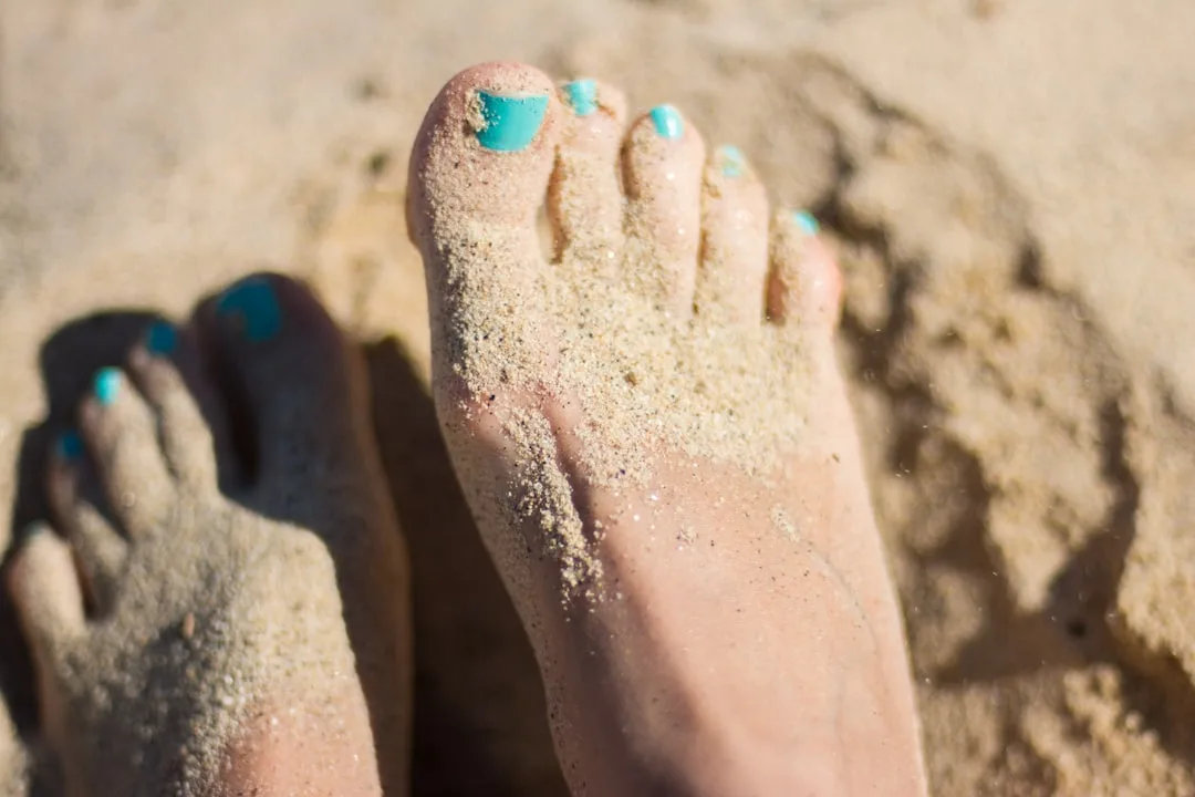 Vitiligo on Feet and Soles: Why It Is Treatment-Resistant