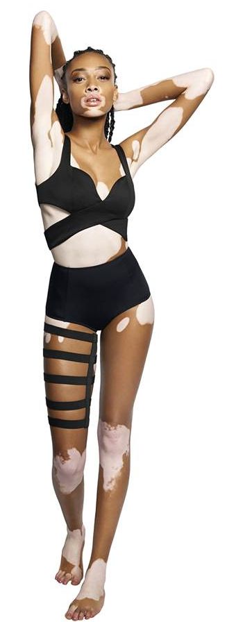 Winnie Harlow and Vitiligo: Why Representation Matters