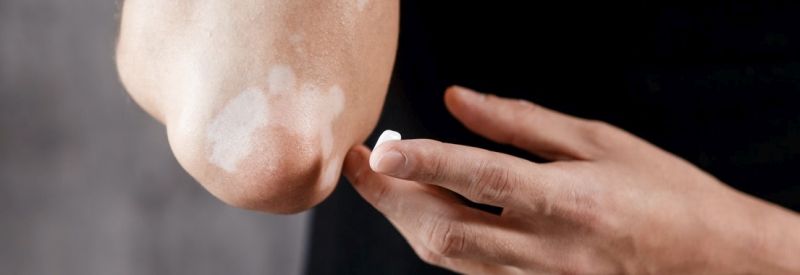 Ruxolitinib Cream for Vitiligo: Promising, Prescription-Only, and Not for Everyone