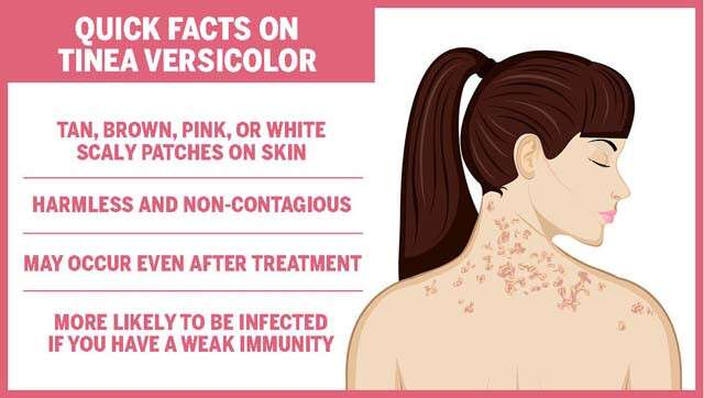 What Is The Difference Between Tinea Versicolor And Vitiligo