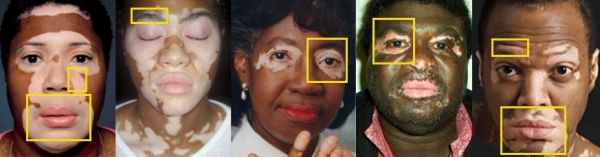 Vitiligo Diagnosis and Treatment: What Usually Happens Next