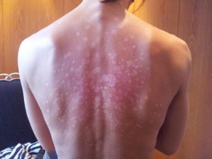 affected by vitiligo