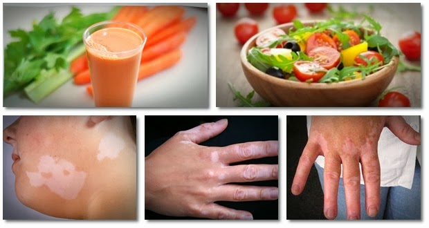 Vitiligo Home Remedies