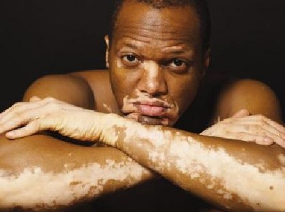 Psychological aspects of dealing with Vitiligo