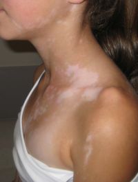 Vitiligo Symptoms and Growth Patterns
