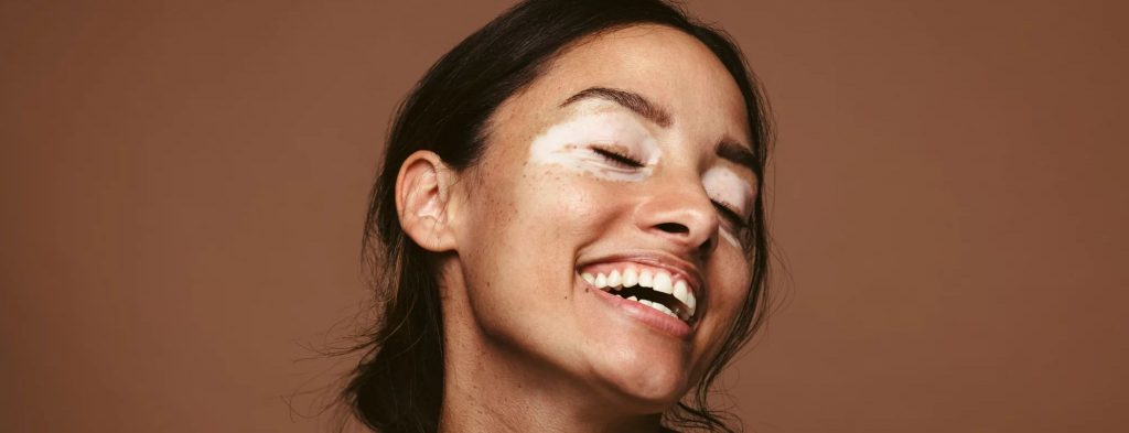 vitiligo around eyes