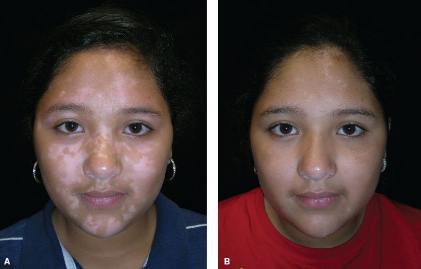Vitiligo in Children