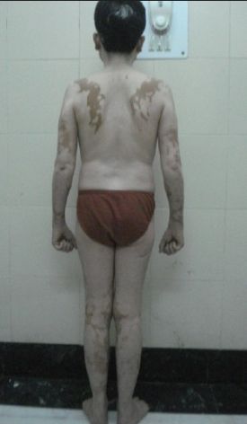 vitiligo physical examination