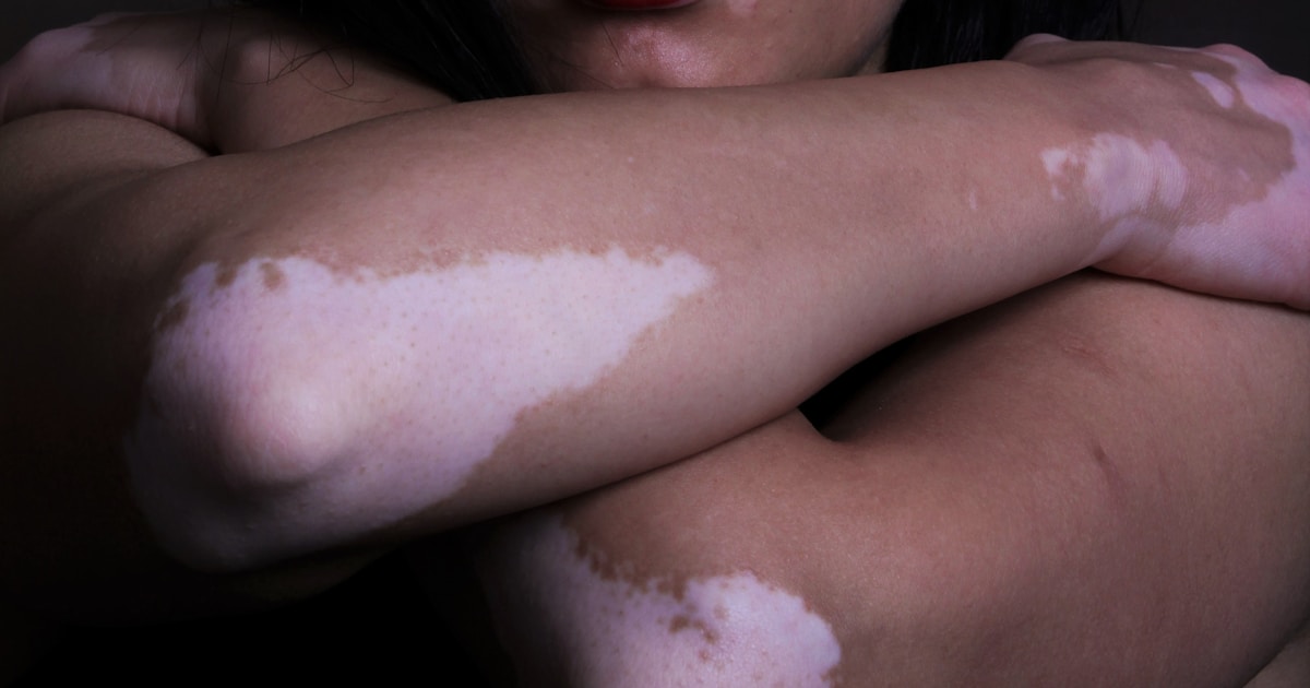 Vitiligo Treatment Options Compared: What the Evidence Actually Says (2026)