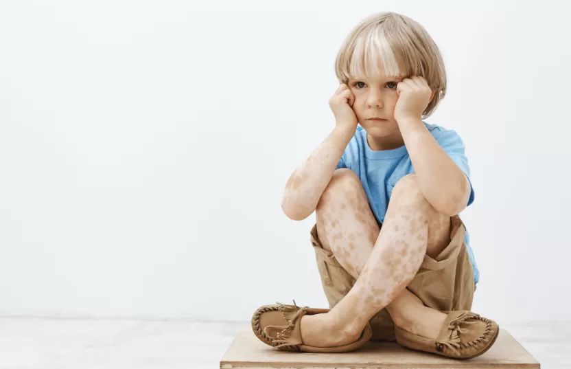 Is Calcipotriol Effective for Vitiligo in Children?