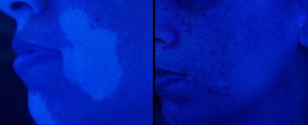 Using a Wood's Lamp to Detect Vitiligo